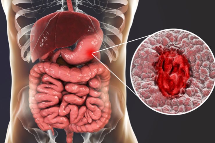 Perforated Ulcers